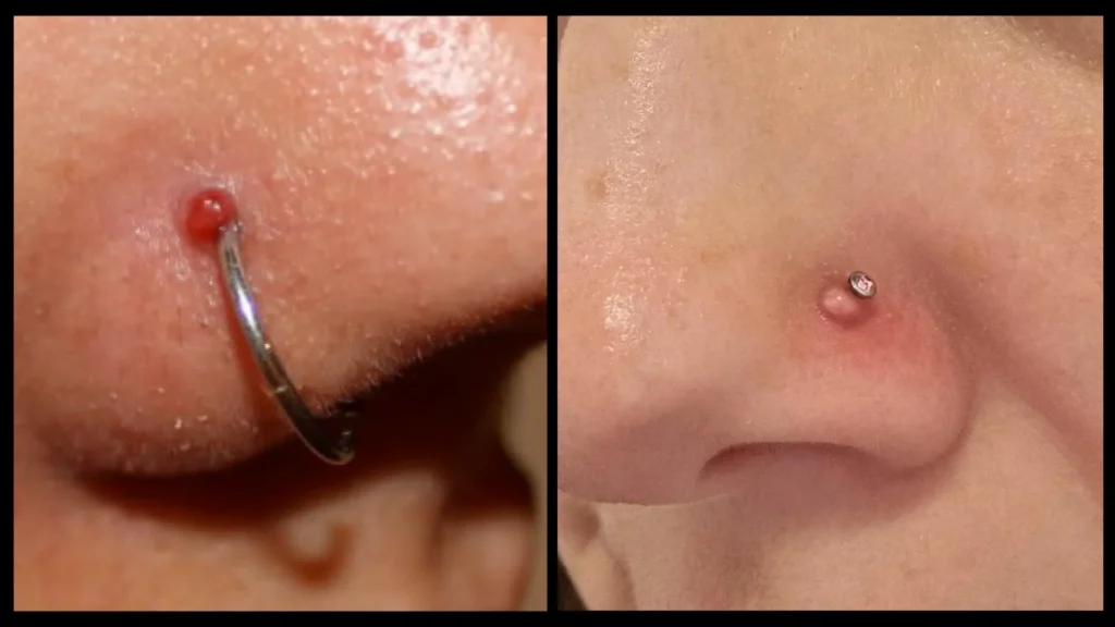boulička u nostril piercingu