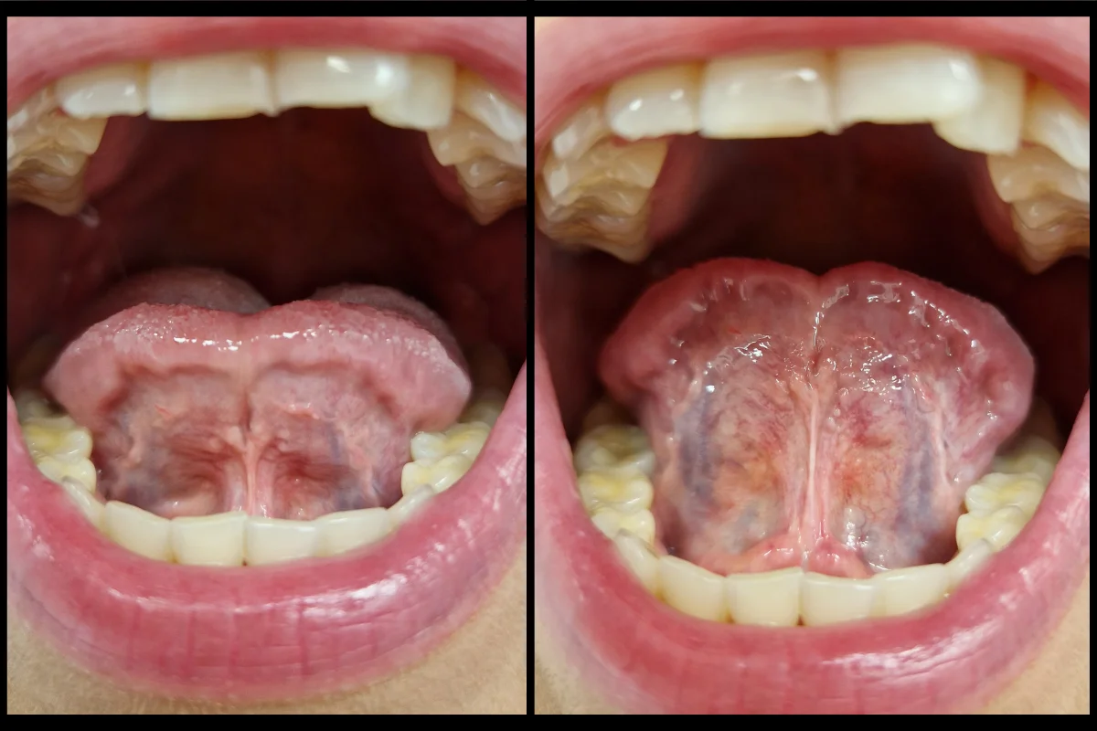 Krátky jazyk, nevhodný pro aplikaci piercingu